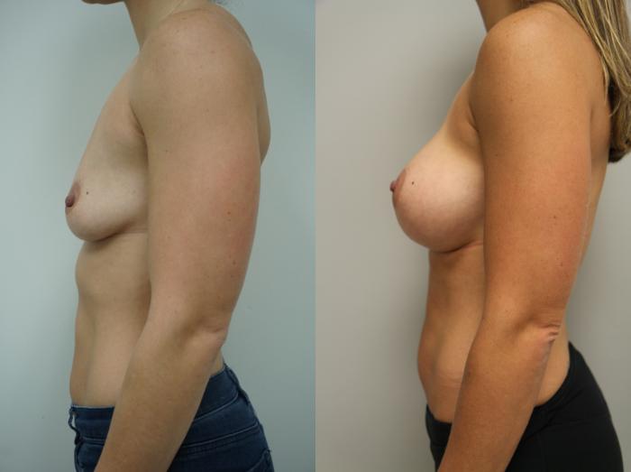 Before & After Breast Augmentation Case 116 View #2 View in Gilbert, AZ