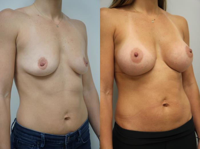 Before & After Breast Augmentation Case 116 View #3 View in Gilbert, AZ