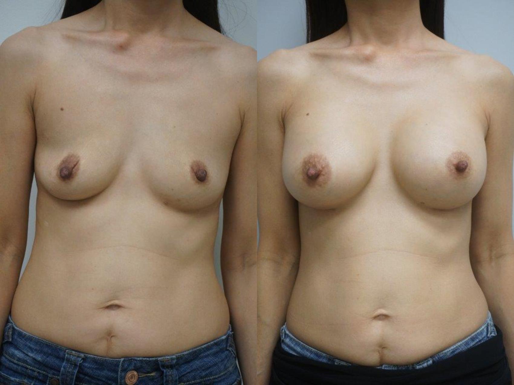 Before & After Breast Augmentation Case 120 View #1 View in Gilbert, AZ