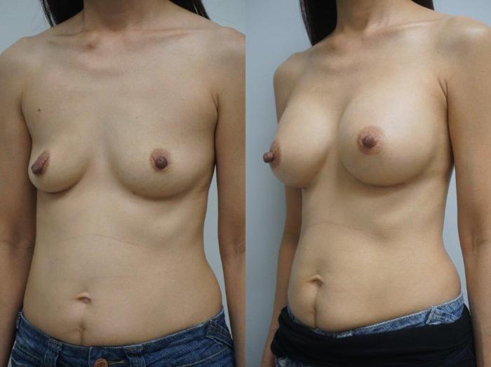 Before & After Breast Augmentation Case 120 View #2 View in Gilbert, AZ