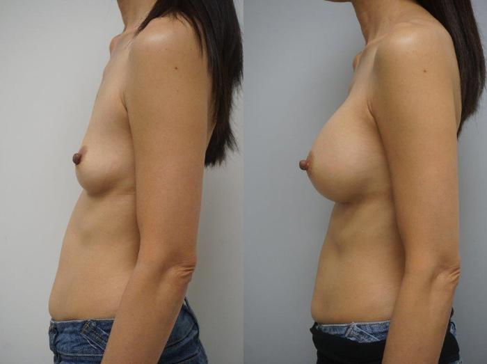 Before & After Breast Augmentation Case 120 View #3 View in Gilbert, AZ
