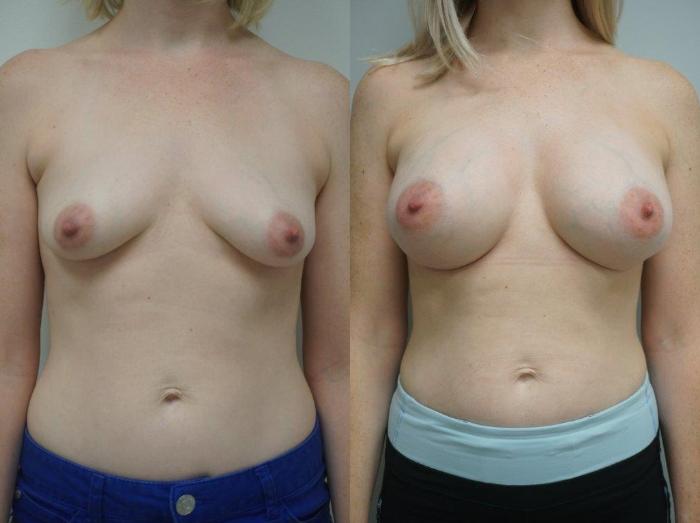 Before & After Breast Augmentation Case 121 View #1 View in Gilbert, AZ