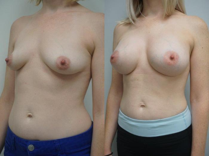 Before & After Breast Augmentation Case 121 View #2 View in Gilbert, AZ