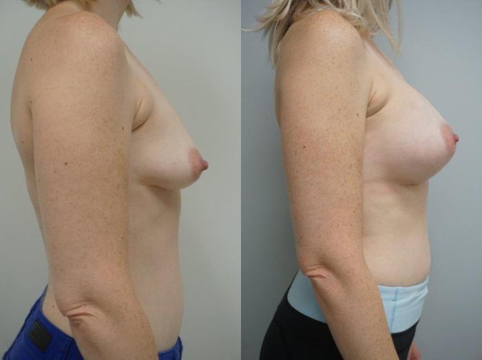 Before & After Breast Augmentation Case 121 View #3 View in Gilbert, AZ