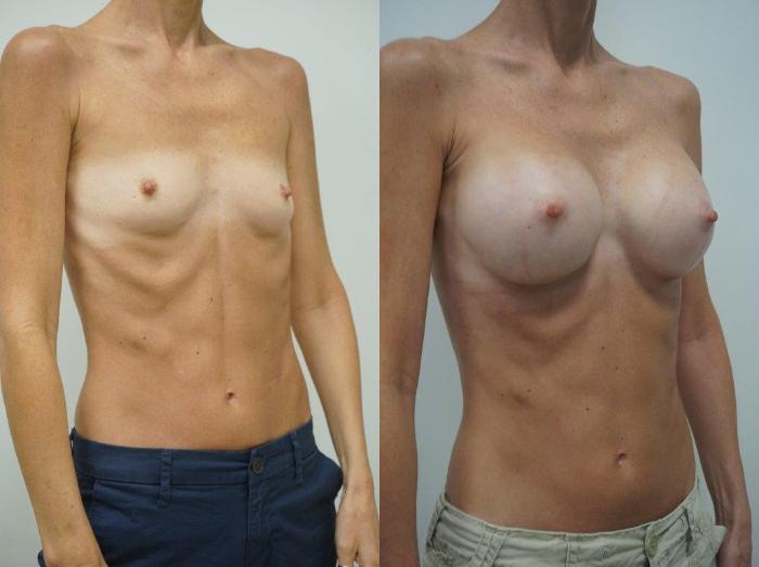 Before & After Breast Augmentation Case 126 View #1 View in Gilbert, AZ