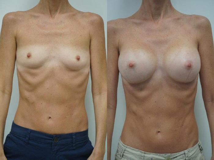 Before & After Breast Augmentation Case 126 View #2 View in Gilbert, AZ