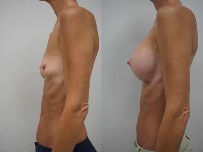 Before & After Breast Augmentation Case 126 View #3 View in Gilbert, AZ