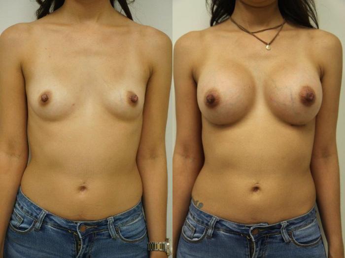 Before & After Breast Augmentation Case 127 View #1 View in Gilbert, AZ