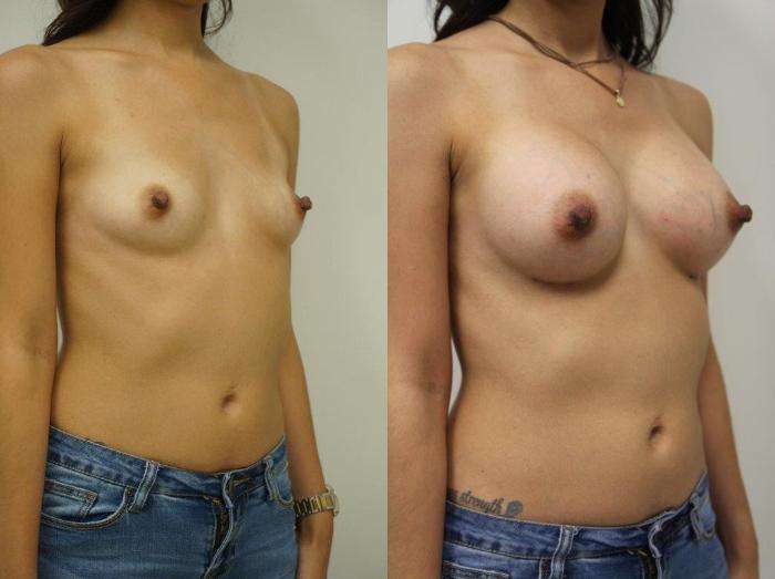 Before & After Breast Augmentation Case 127 View #2 View in Gilbert, AZ
