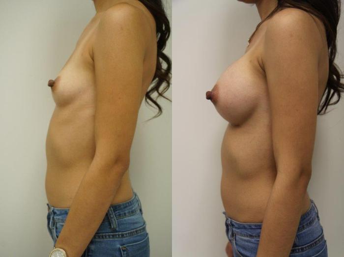 Before & After Breast Augmentation Case 127 View #3 View in Gilbert, AZ