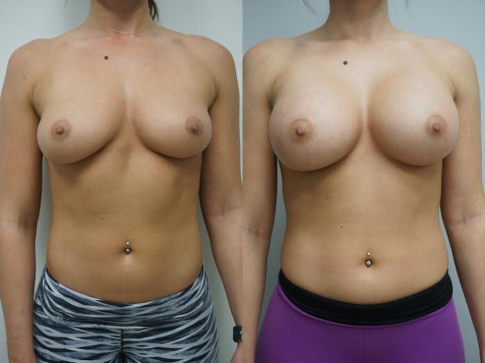 Before & After Breast Augmentation Case 129 View #1 View in Gilbert, AZ