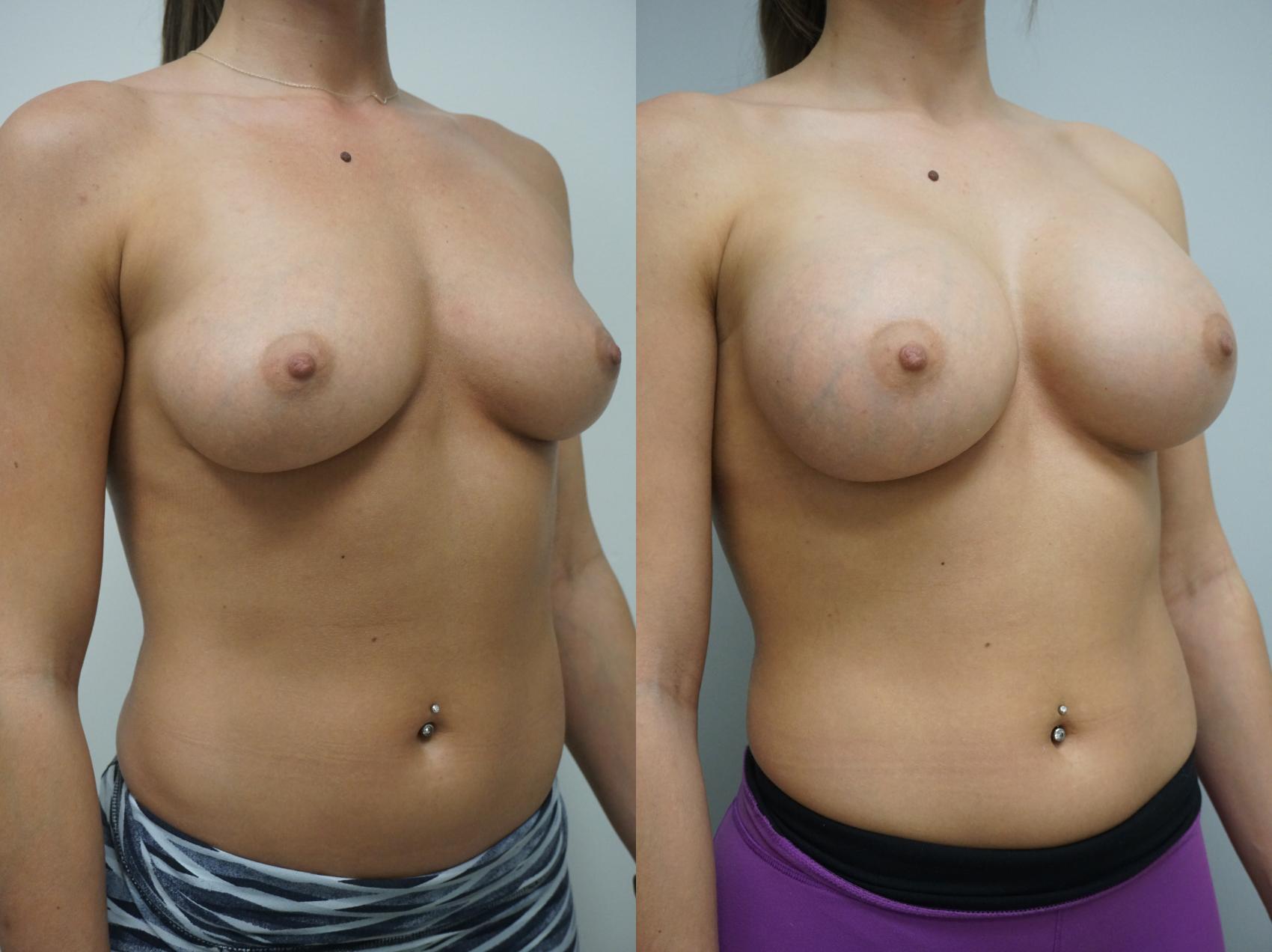 Before & After Breast Augmentation Case 129 View #2 View in Gilbert, AZ