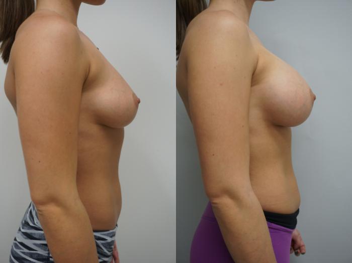 Before & After Breast Augmentation Case 129 View #3 View in Gilbert, AZ