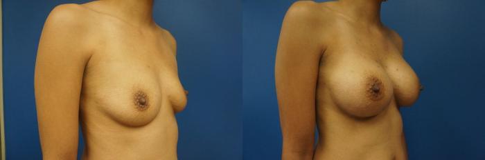Before & After Breast Augmentation Case 13 View #1 View in Gilbert, AZ