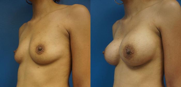 Before & After Breast Augmentation Case 13 View #2 View in Gilbert, AZ
