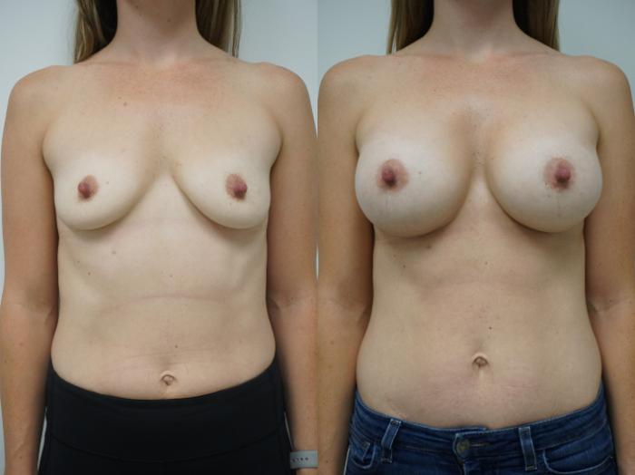 Before & After Breast Augmentation Case 130 View #1 View in Gilbert, AZ