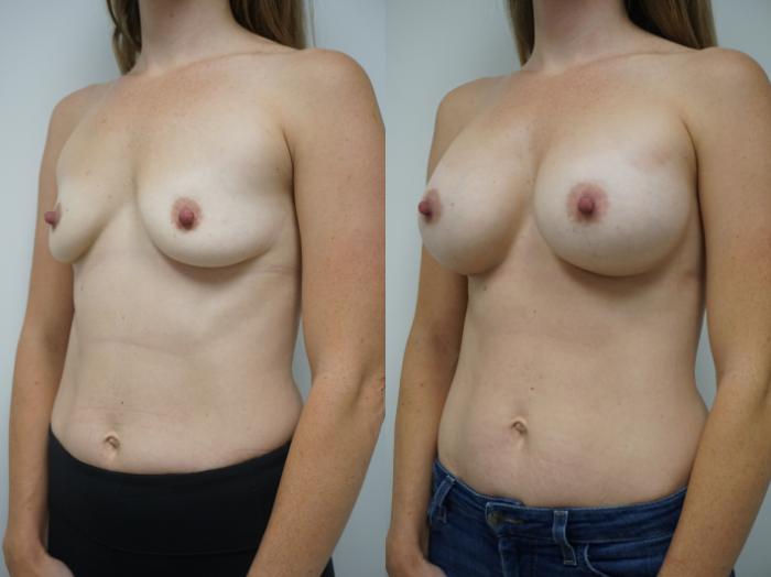 Before & After Breast Augmentation Case 130 View #2 View in Gilbert, AZ