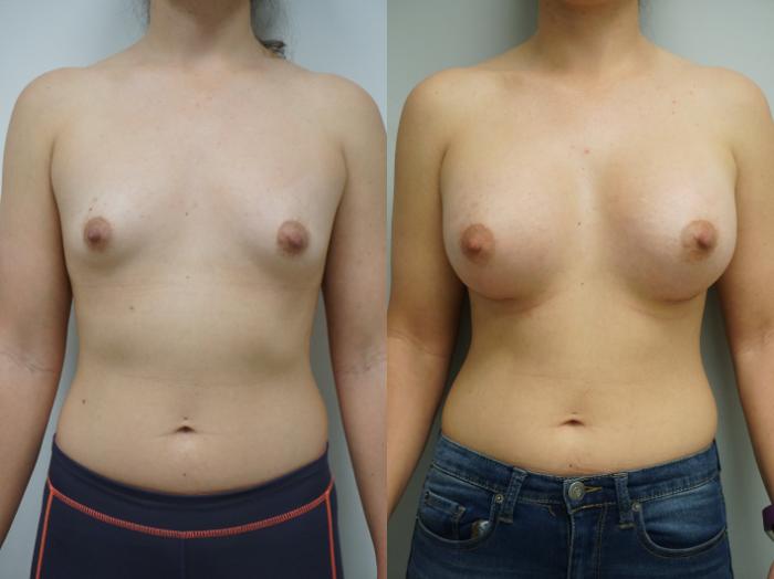 Before & After Breast Augmentation Case 134 View #1 View in Gilbert, AZ