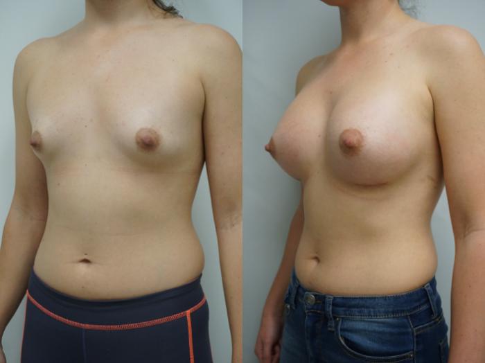 Before & After Breast Augmentation Case 134 View #2 View in Gilbert, AZ