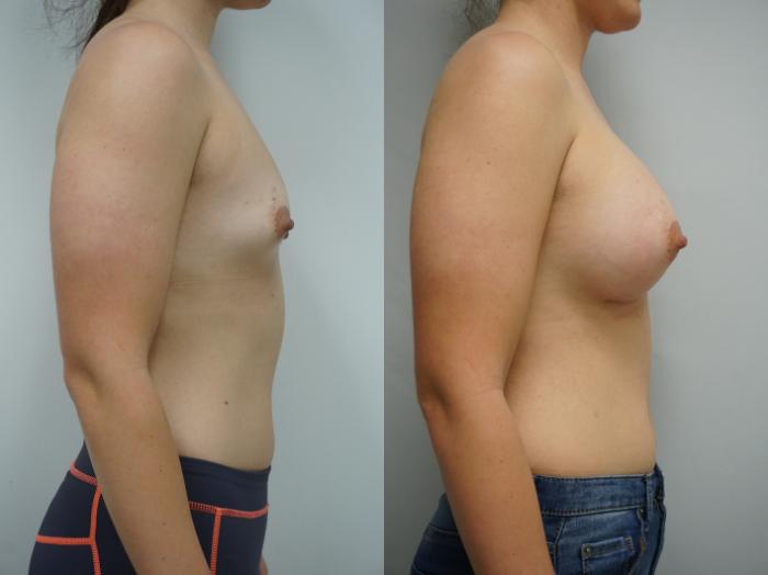 Before & After Breast Augmentation Case 134 View #3 View in Gilbert, AZ
