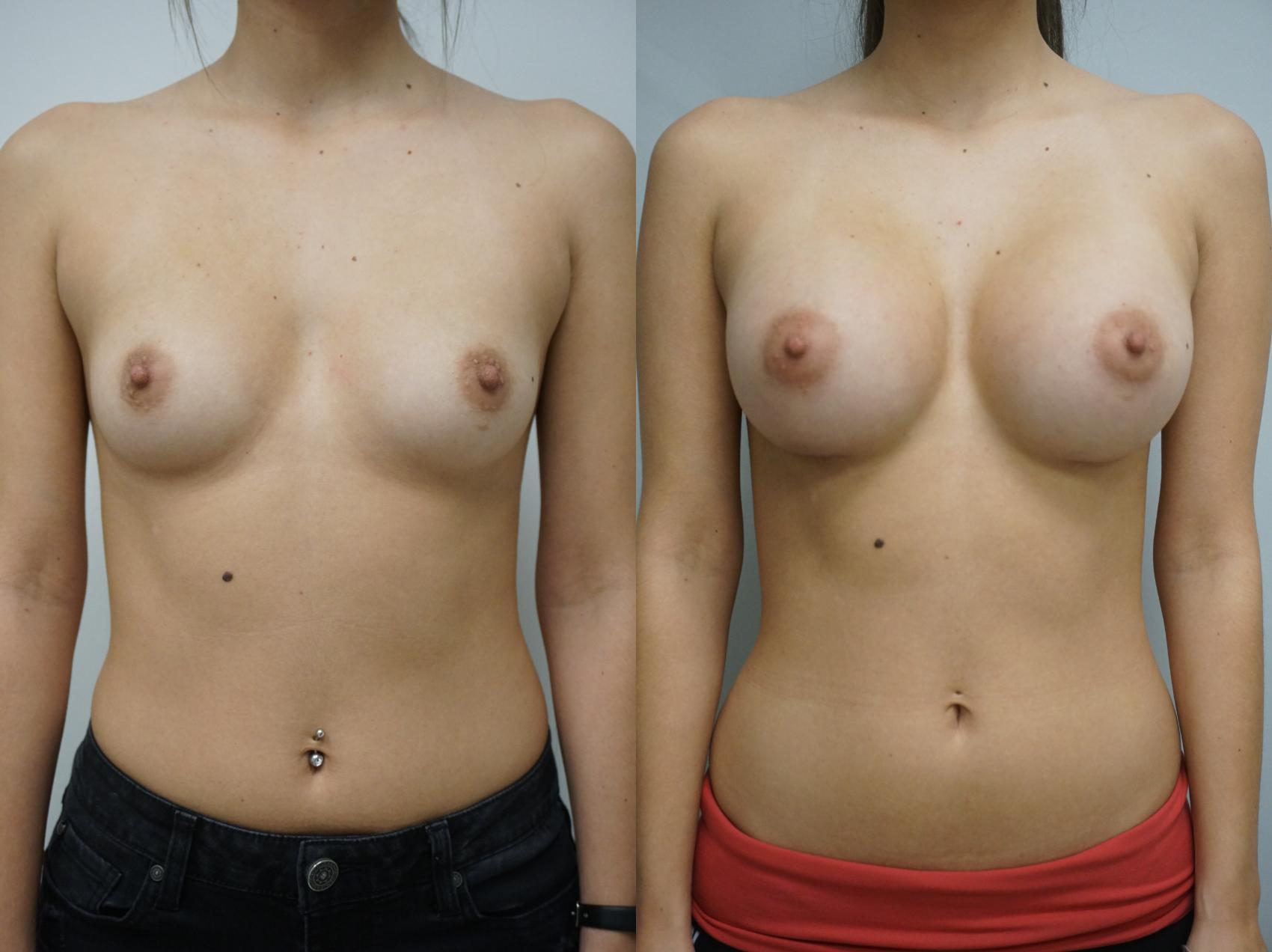 Before & After Breast Augmentation Case 136 View #1 View in Gilbert, AZ