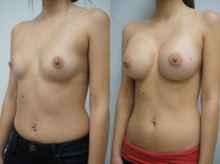 Before & After Breast Augmentation Case 136 View #2 View in Gilbert, AZ