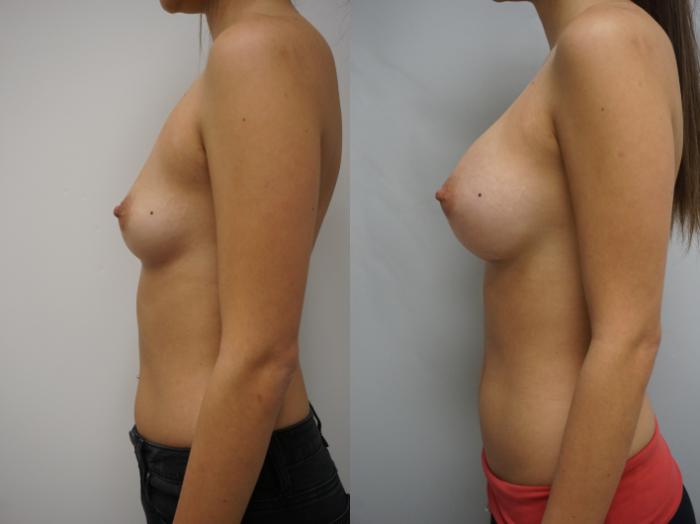 Before & After Breast Augmentation Case 136 View #3 View in Gilbert, AZ