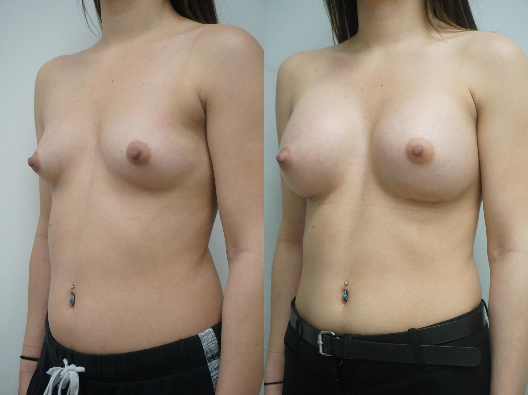 Before & After Breast Augmentation Case 138 View #2 View in Gilbert, AZ