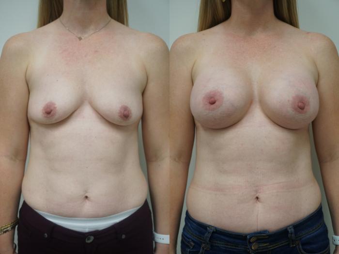 Before & After Breast Augmentation Case 139 View #1 View in Gilbert, AZ