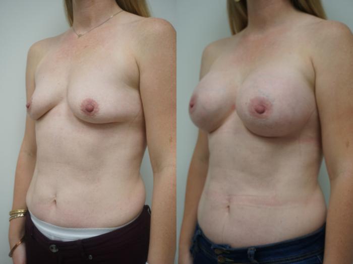 Before & After Breast Augmentation Case 139 View #2 View in Gilbert, AZ