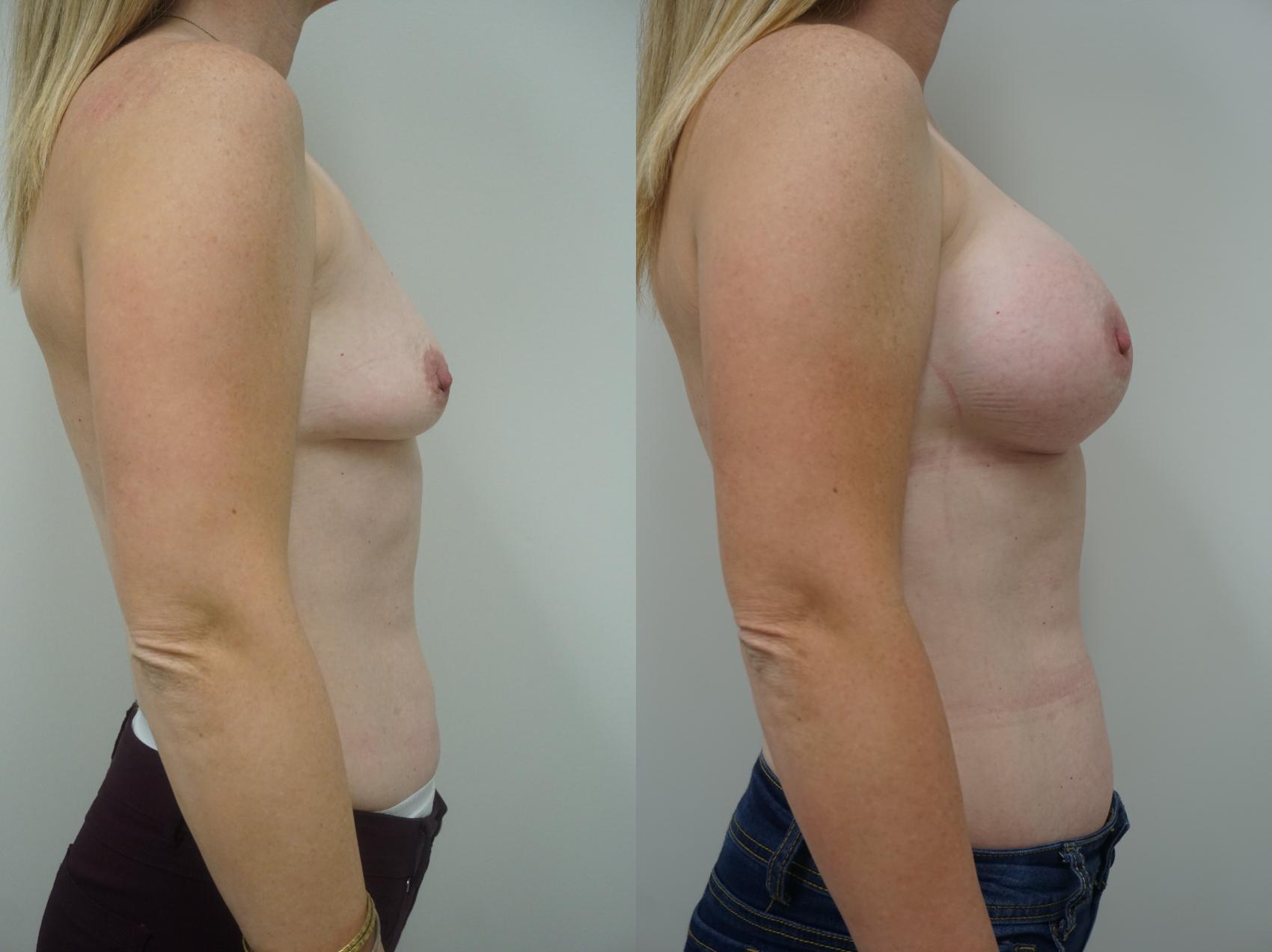 Before & After Breast Augmentation Case 139 View #3 View in Gilbert, AZ