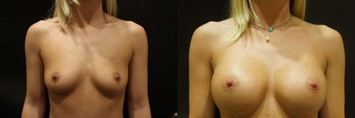 Before & After Breast Augmentation Case 14 View #1 View in Gilbert, AZ
