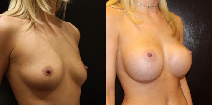 Before & After Breast Augmentation Case 14 View #3 View in Gilbert, AZ