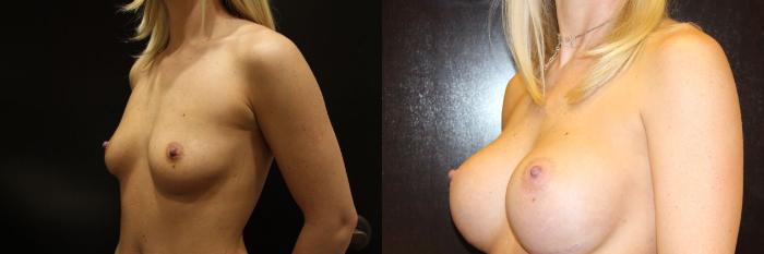 Before & After Breast Augmentation Case 14 View #5 View in Gilbert, AZ