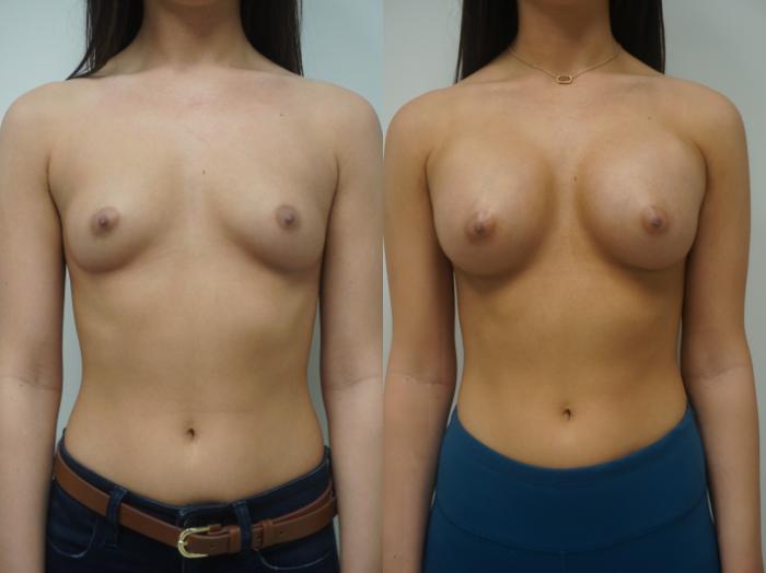 Before & After Breast Augmentation Case 140 View #1 View in Gilbert, AZ