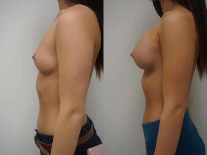 Before & After Breast Augmentation Case 140 View #2 View in Gilbert, AZ