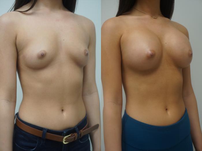 Before & After Breast Augmentation Case 140 View #3 View in Gilbert, AZ