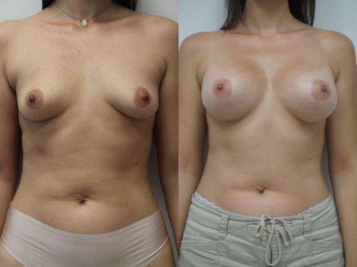 Before & After Breast Augmentation Case 142 View #1 View in Gilbert, AZ