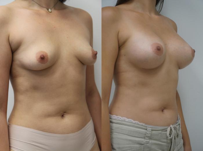 Before & After Breast Augmentation Case 142 View #2 View in Gilbert, AZ