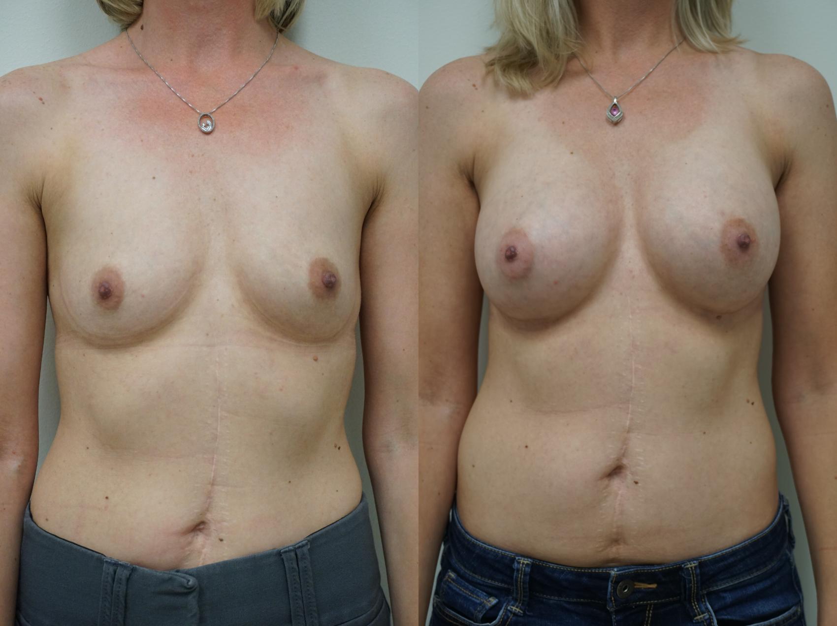 Before & After Breast Augmentation Case 145 View #1 View in Gilbert, AZ