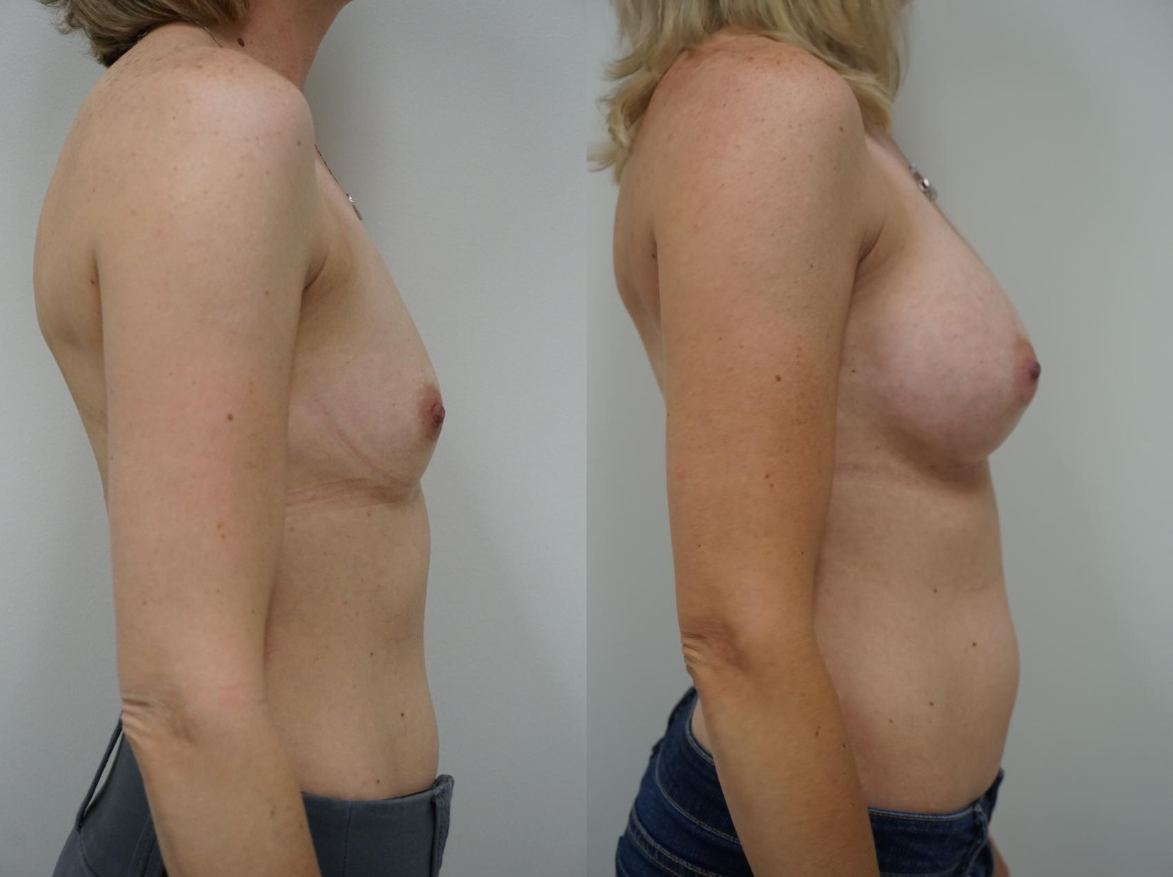 Before & After Breast Augmentation Case 145 View #2 View in Gilbert, AZ