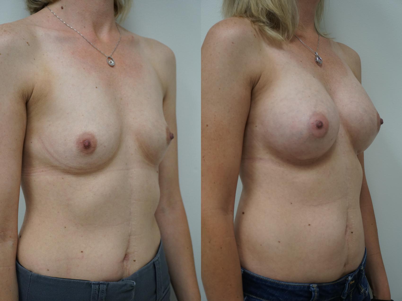 Before & After Breast Augmentation Case 145 View #3 View in Gilbert, AZ