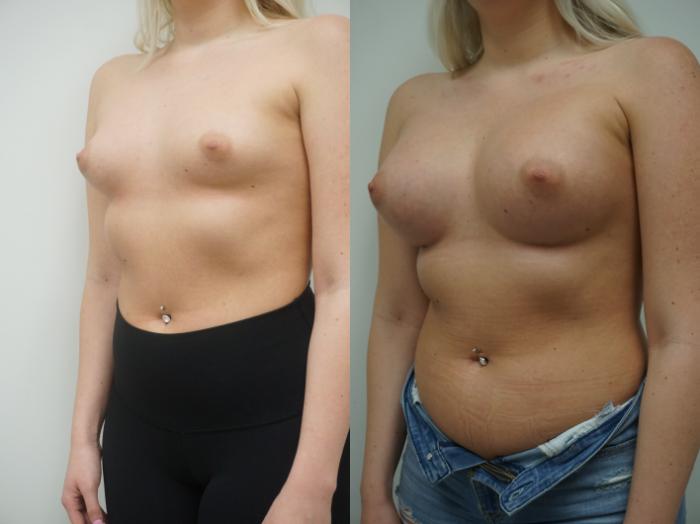 Before & After Breast Augmentation Case 148 View #2 View in Gilbert, AZ