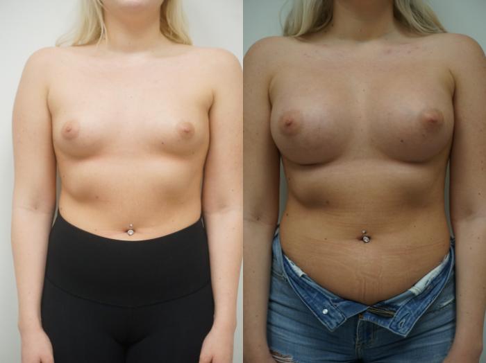 Before & After Breast Augmentation Case 148 View #3 View in Gilbert, AZ