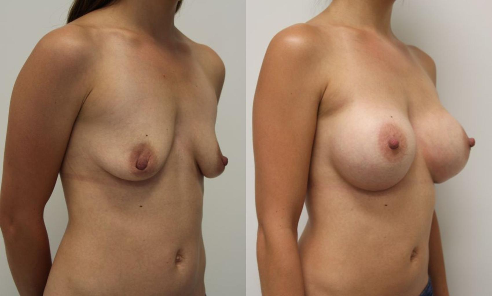 Before & After Breast Augmentation Case 15 View #1 View in Gilbert, AZ