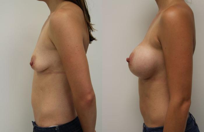 Before & After Breast Augmentation Case 15 View #3 View in Gilbert, AZ