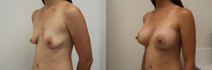 Before & After Breast Augmentation Case 15 View #5 View in Gilbert, AZ
