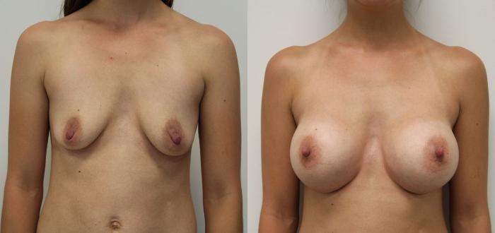 Before & After Breast Augmentation Case 15 View #6 View in Gilbert, AZ