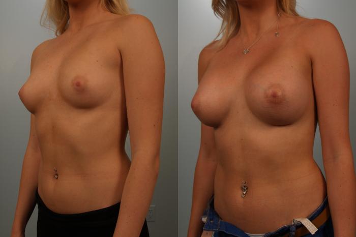 Before & After Breast Augmentation Case 151 View #1 View in Gilbert, AZ