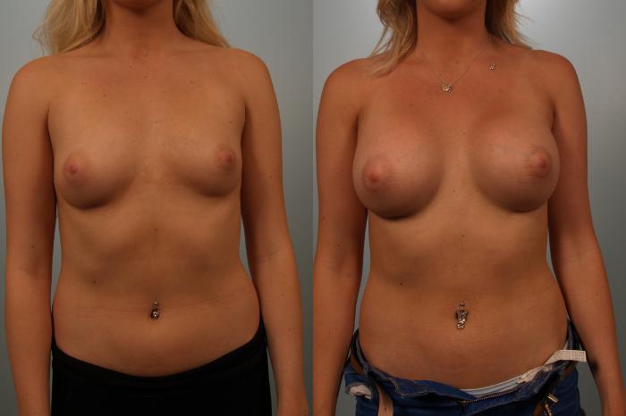 Before & After Breast Augmentation Case 151 View #2 View in Gilbert, AZ